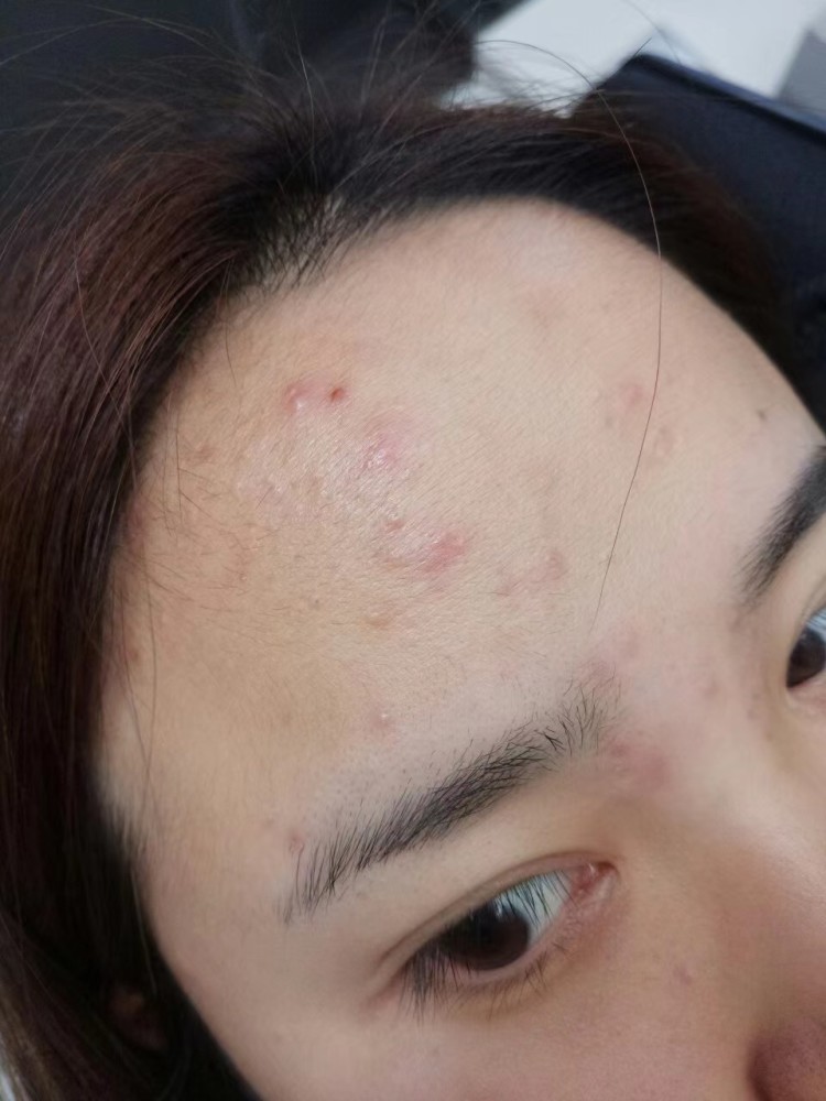 保证一天的充足睡眠,按时,上床睡觉,注意多喝水原因:额头上长痘痘说明