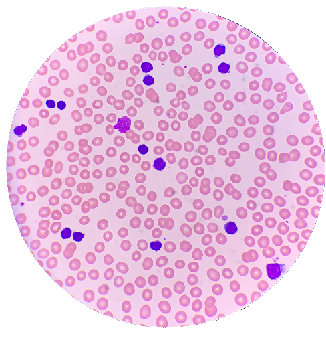 涂抹细胞对白细胞分类的影响及其在形态学诊断中的作用