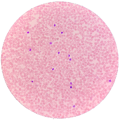 涂抹细胞对白细胞分类的影响及其在形态学诊断中的作用