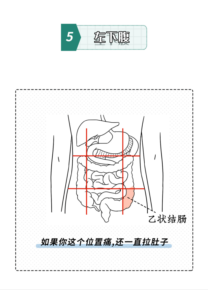 这是乙状结肠炎得了这个病,便意会特别浓稍微严重一点的一天起码要上