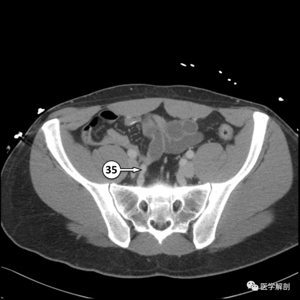 5分钟看完这篇学会全腹ct解剖