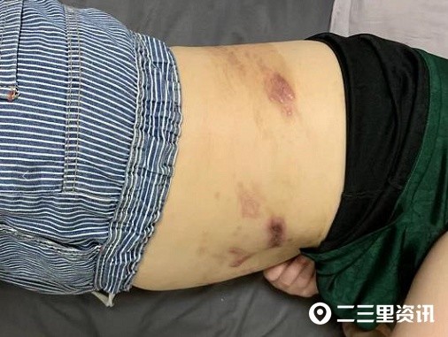 "当时我坐在第三排,电瓶压到我肚子上,造成腰腹部三级烫伤,右肱骨粉碎