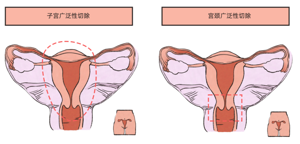 而更让晓丽无法接受的是:这一类的宫颈癌原则上要通过手术把宫颈连同