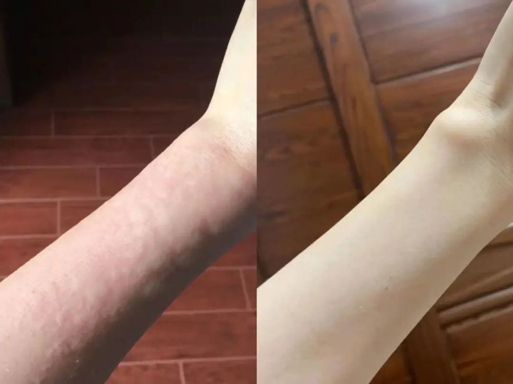 荨麻疹痒的老想挠?过来人亲测7天消疹法!_腾讯新闻