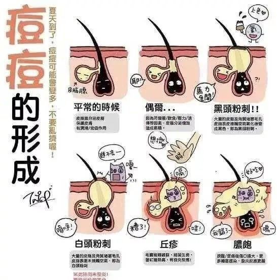 痘痘的類型及形成原因在分享之前,還是先給大家梳理下痘痘的類型和