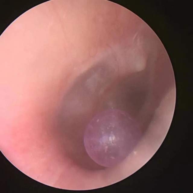 异物入耳莫乱抠!最全处理方法看这里,关键时刻用得上_腾讯新闻