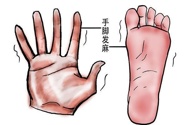 手脚麻木,可能与这4种心脑血管疾病有关,别不当回事