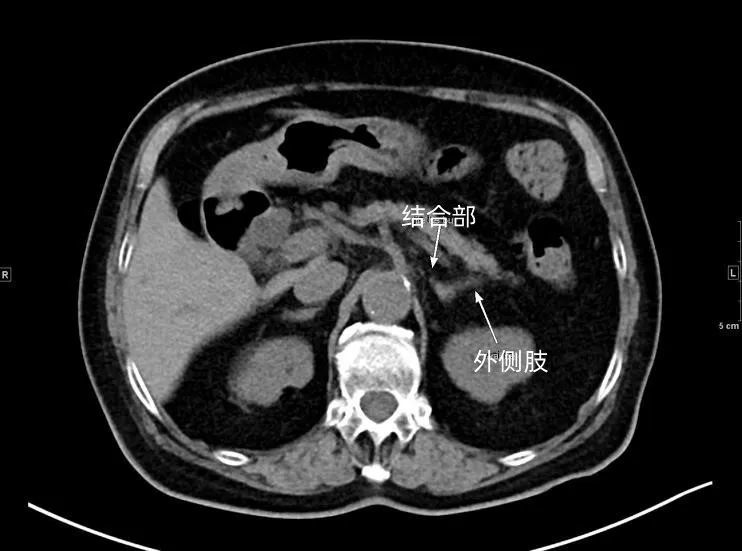 ct平掃:腎呈圓形或橢圓形軟組織密度影,邊緣光滑,密度均勻,皮質和髓質