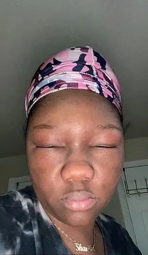 了…这款染发剂里有一种成分"苯二胺",简称ppd,莎妮卡就是对pdd过敏了