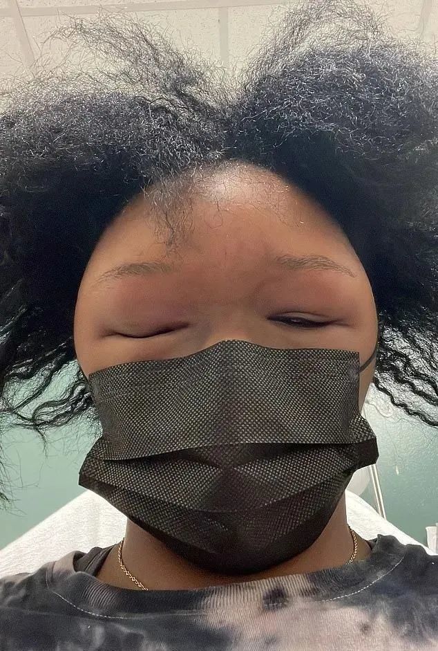 美国妹子染头发过敏全脸肿成emoji,不光"失明"还险些窒息