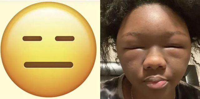 此刻,她的脸已经肿成圆形,活脱脱一个emoji表情包…到了下午,莎妮卡的