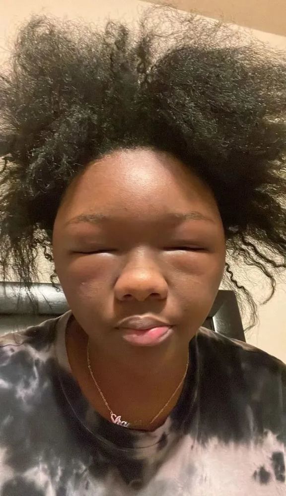 美国妹子染头发过敏全脸肿成emoji,不光"失明"还险些窒息_腾讯新闻