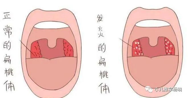 济南小儿推拿杨晓孩子扁桃体发炎是怎么回事怎样做好护理预防