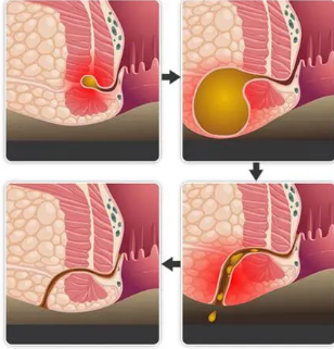 好的手术,也有损伤,造成细菌感染,容易反复,同时一旦损伤性肛门病出现