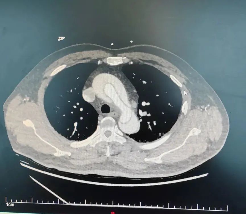 经冠脉ct,主动脉cta等检查,诊断为a型主动脉夹层,已经累及肠系膜上