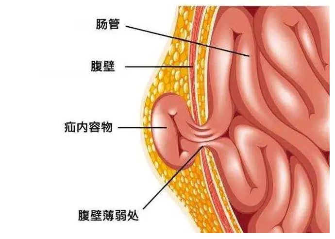 疝,来无影,去无踪,如气体一样,民间俗称为"疝气"或"小肠气".