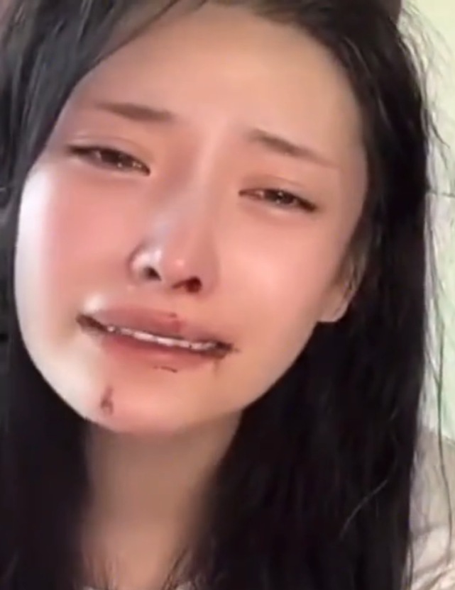 鼻子被男友打歪鼻血狂流,开直播控诉全程嘶吼