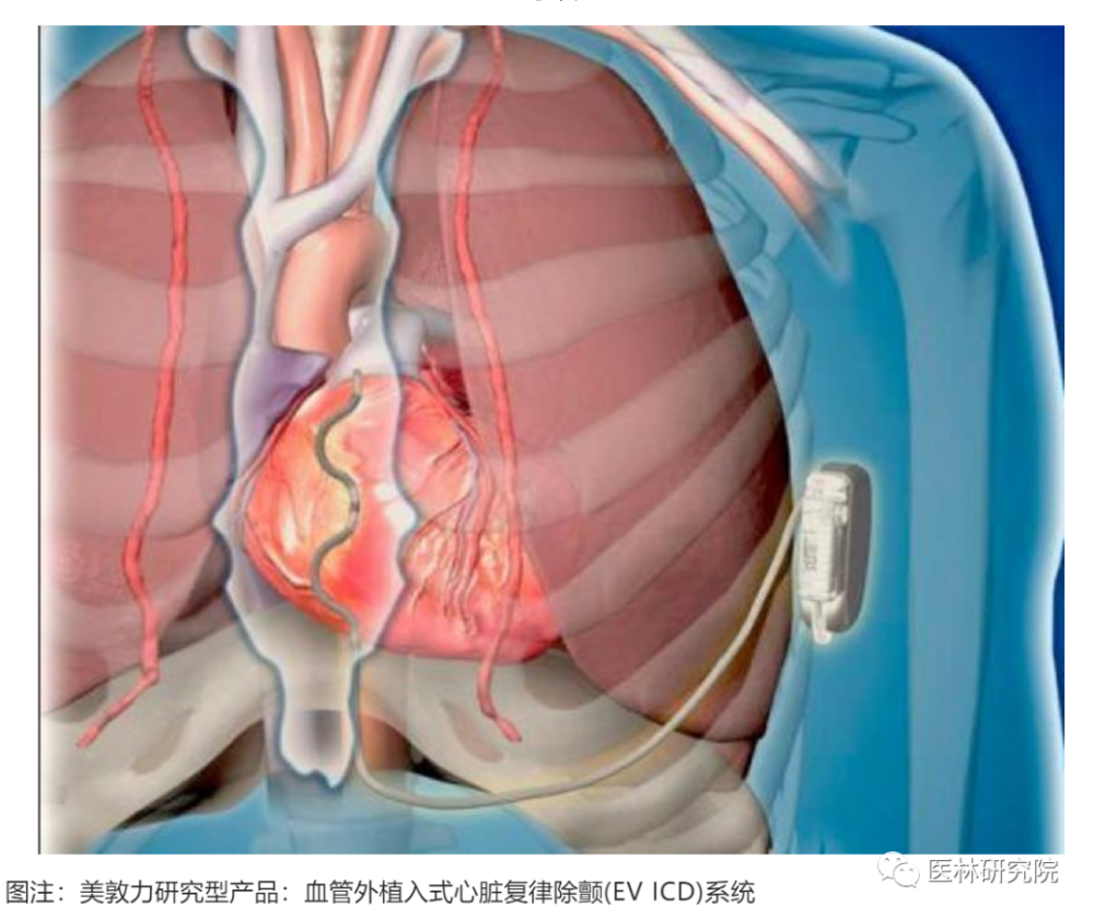 有效性98.7％！美敦力血管外ICD临床试验结果优越_腾讯新闻