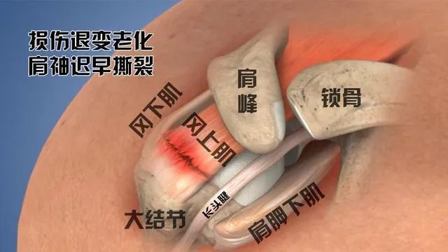 肩周炎有哪些症状表现?缓解症状有什么妙法?