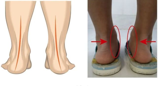 孩子鞋底的一个情况,可能暗示着"足外翻",家长不能大意了