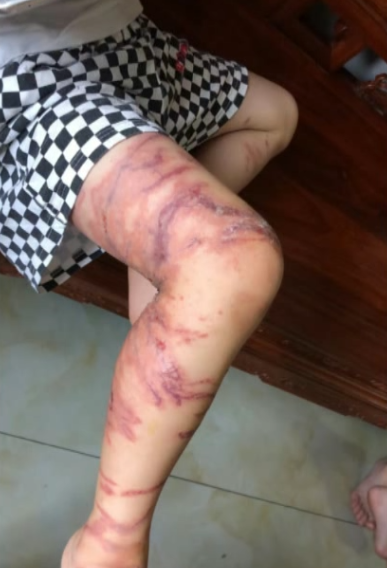 起初,杨先生还以为孩子踩到玻璃金属一类的东西,便快速将他抱了起来