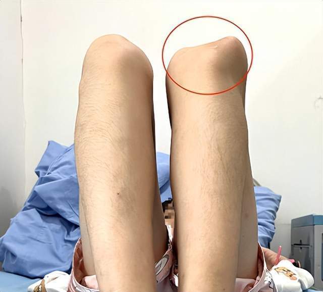 背后原因竟是髌骨脱位在作崇