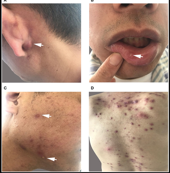 白塞病又稱為貝赫切特病,都是behcets disease的音譯,屬於一種