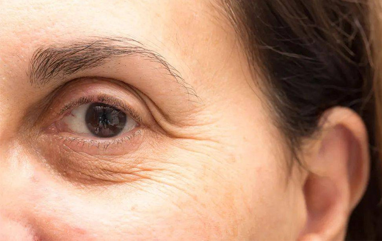 【深圳艺星】眼皮松弛怎么解决?插图