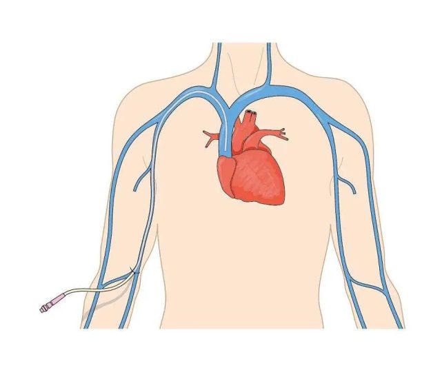picc导管全称是经外周静脉置入的中心静脉导管,它是一根很细的,柔软的