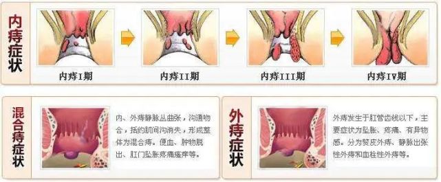 3.炎性外痔:由於結締組織性外痔循環受阻所導致的局部水腫.