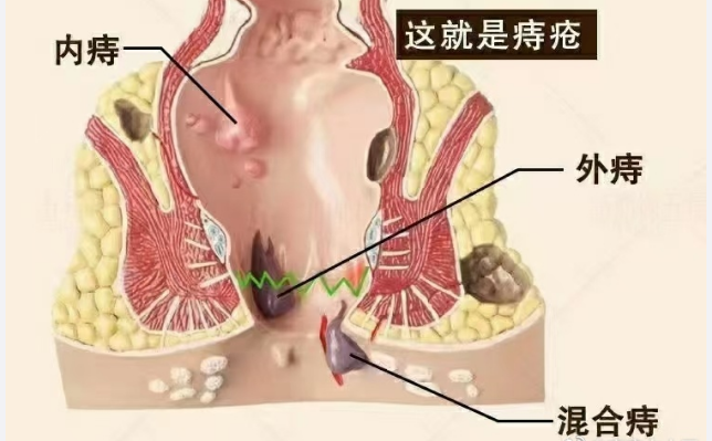 怎么样才能让痔疮远离自己?_腾讯新闻