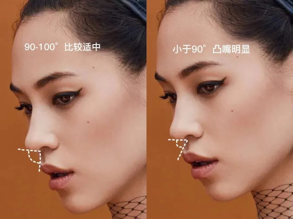 治疗凸嘴费时费力又花钱,而如果你满足了三点一线和鼻唇角适中,便大可