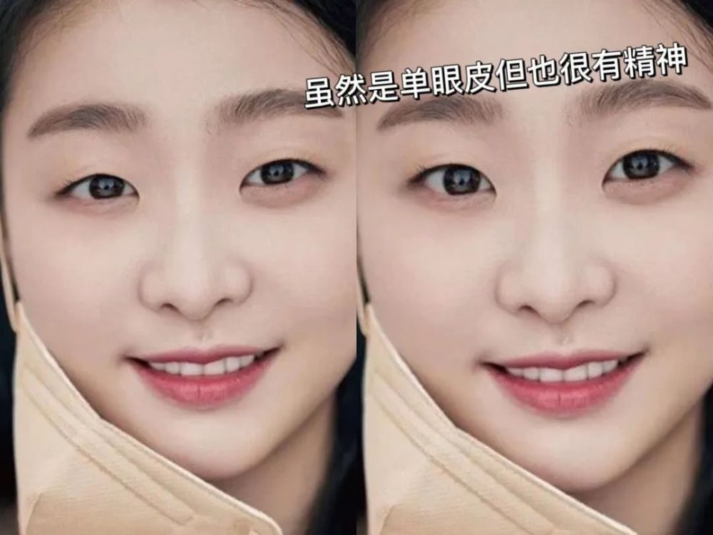 单眼皮、泪沟、凸嘴、方腮等，才是“小美女”的重中之重