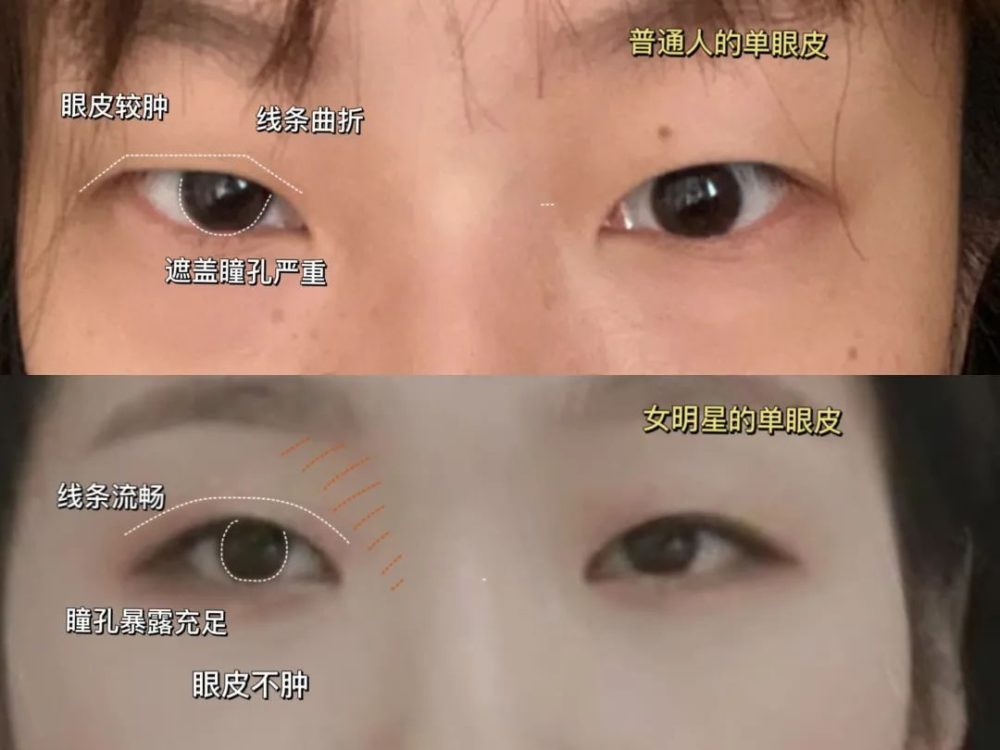 单眼皮、泪沟、凸嘴、方腮等，才是“小美女”的重中之重