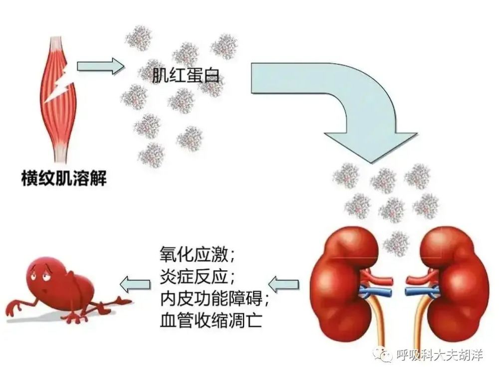 过量运动肌肉溶解图片