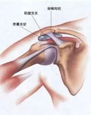 冈上肌肌腱炎,肩膀疼痛抬不起来该怎样康复?