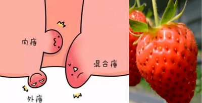 痔疮用什么药最有效?