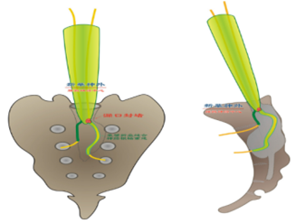 揭开"腹痛另一个迷"-骶管囊肿
