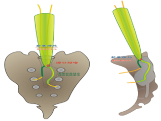 骶管囊肿位置示意图图片