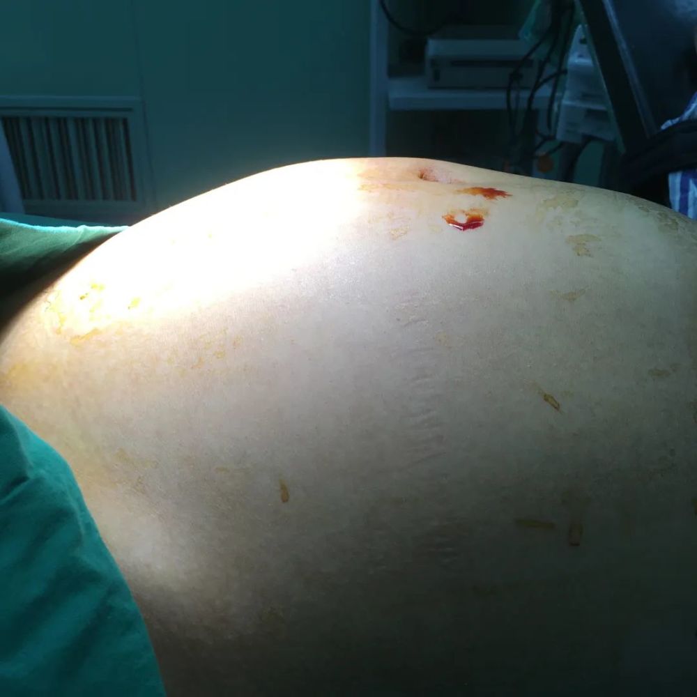 来温州市人民医院检查b超提示卵巢肿瘤可能(盆腹腔内见一巨大囊性包块