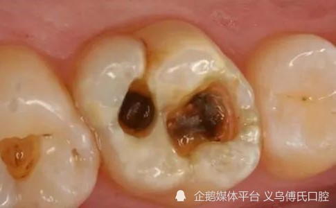 治疗牙齿深龋的注意事项