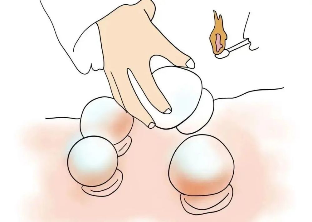 针灸后他高烧不退?浙一专家:这些地方不要随便去_腾讯新闻