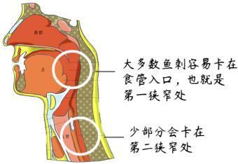 鱼刺卡喉,吞下一口饭后,阿叔被送到医院做了一个大手术
