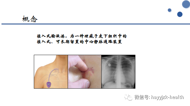 输液港植入位置图片图片