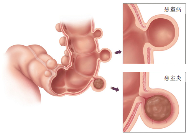 来自查:憩室病,结肠最常见的非癌性病变