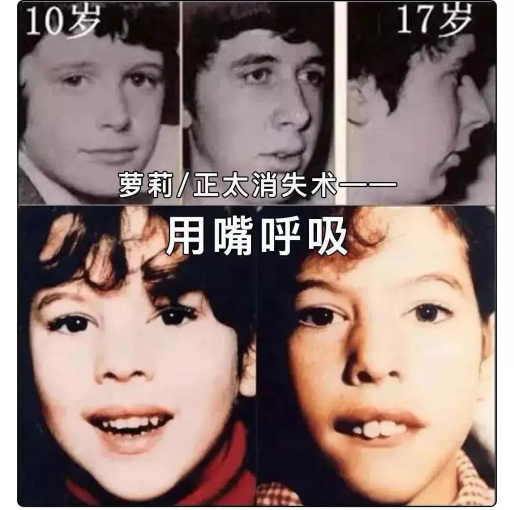 对,你没看错,就是变丑,还有黑眼圈,大门牙,腺样体面容(腺样体肥大