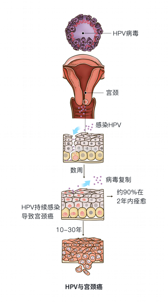 圖片來源:騰訊醫典而絲狀疣,感染的是低危型hpv.