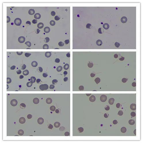 血涂片镜检如下入院检查结果:wbc 16.85×109/l,rbc 1.