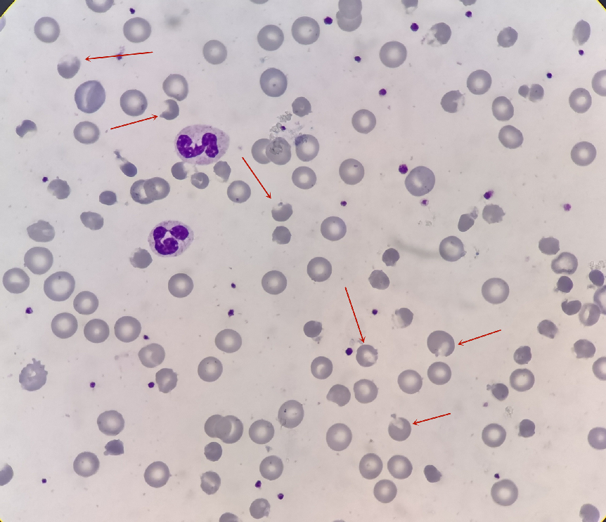 圖1 圖內箭頭所指為水泡紅細胞血塗片鏡檢如下入院檢查結果:wbc 16.