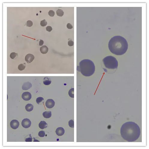 水泡,咬痕,不规则收缩红细胞,海因小体,一张血片看全了……_腾讯新闻
